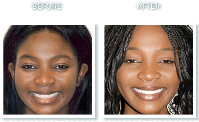 Bolton Ma Dr - People With Invisalign With An Overbite (650x439), Png Download