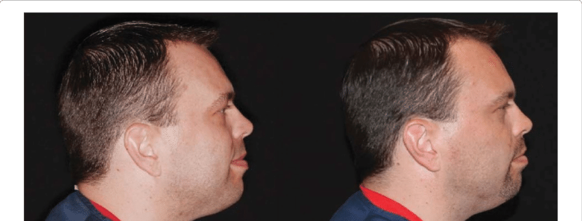 The Changes In Facial Profile And Head Posture In A - Forward Head Posture (850x323), Png Download