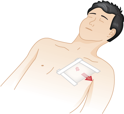 Penetrating Chest Wound - Penetrating Chest Wound First Aid (430x393), Png Download