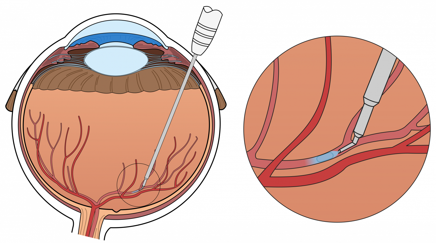 Surgical Eye Robot Performs Precision-injection In - Central Retinal Vein Occlusion Treatment (1500x837), Png Download