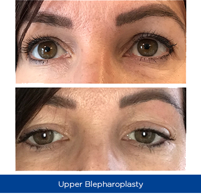 This Is An Amazing Alternative To Laser, It Is Visually - Nottinghamshire (395x383), Png Download