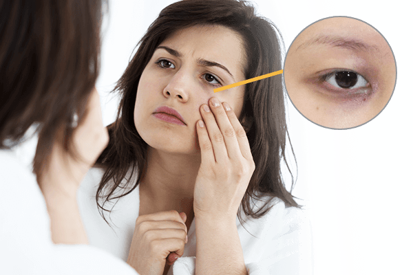 Dark Eye Circles - Periorbital Puffiness (600x400), Png Download