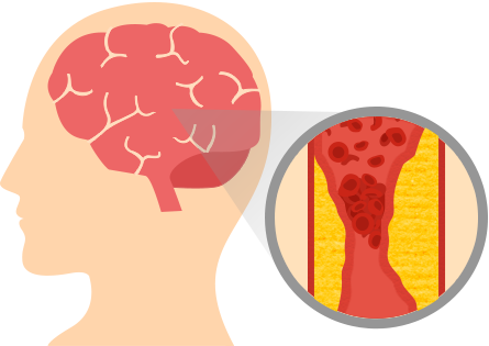 Stroke - Stroke Disease (445x315), Png Download