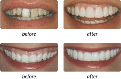 Are You Considering A Complete Smile Makeover - Lumineers (420x290), Png Download