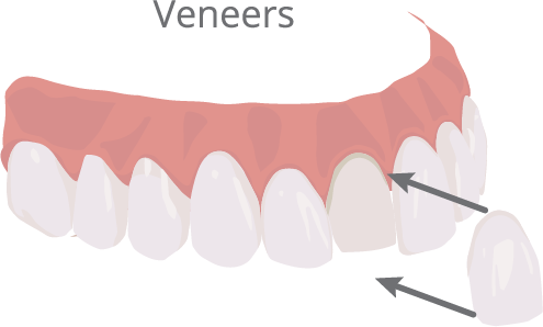 Veneers Illustration - Illustration (495x298), Png Download