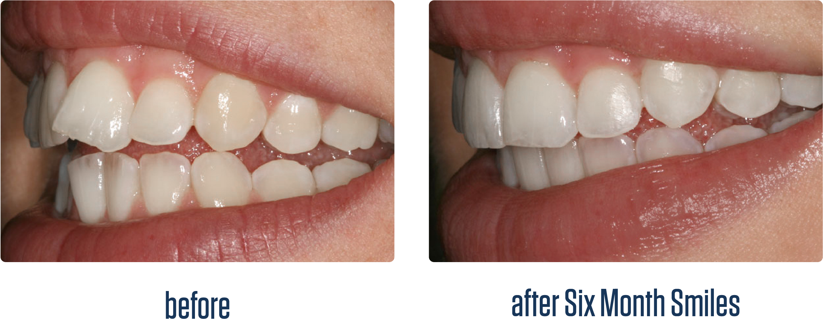 Six Month Smiles Before And After Photo - Six Month Smiles Before And After (3300x1431), Png Download