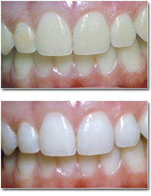 Teeth Whitening Orland Park Dr - Level Of Teeth Whitening (318x410), Png Download