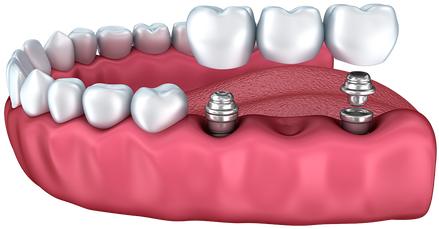 Implantprocedure - Dental Implant (500x285), Png Download