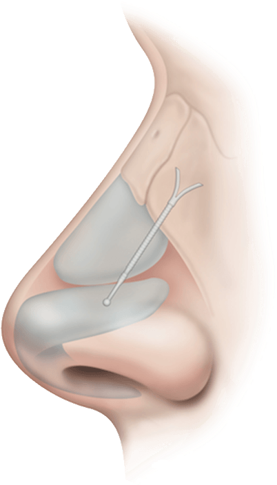 Absorbable Nasal Implant - Stryker Corporation (1240x760), Png Download