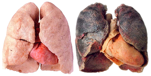 Healthy Lung And Smokers Lung - Kick Smoking And Kick Cancer: Fastest And Best Guide (600x303), Png Download