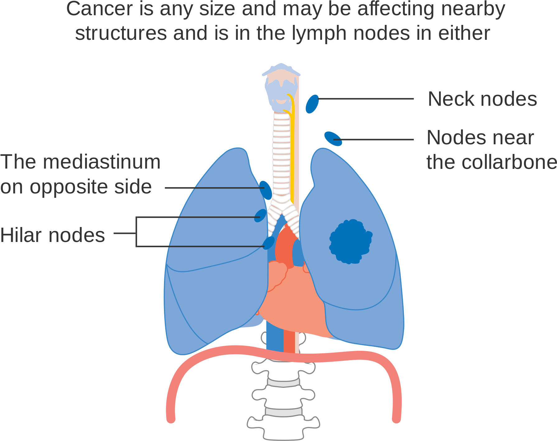 Open - Lung Cancer (2000x1624), Png Download