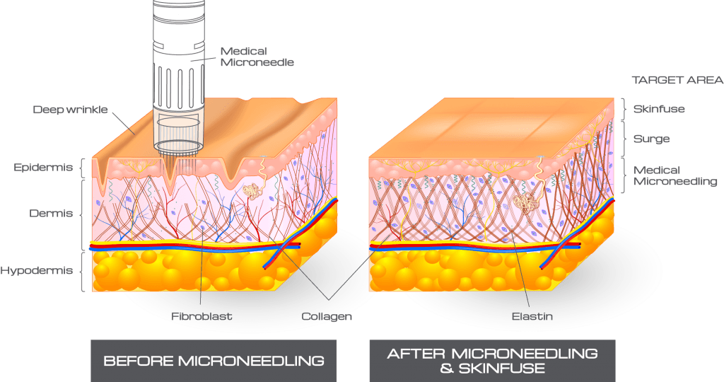 Micropuncion Gold Pen De Dermica Nuevo Concepto De - Fibroblast Layer Of Skin (1024x540), Png Download