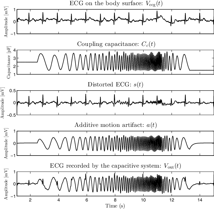 Illustration Of An Ecg Distortion And A Motion Artifact - Artifact (734x734), Png Download