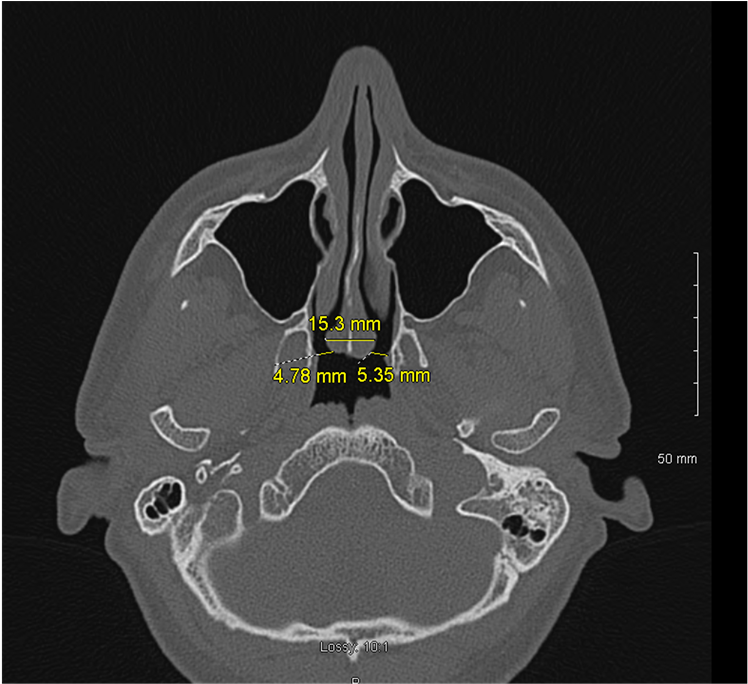 Axial Cut Computed Tomography Image Showing Mucosal - Computed Tomography (903x683), Png Download