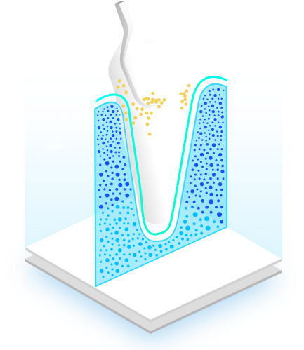 Raspado Radicular Deep Cleaning - Dental Implant (575x500), Png Download