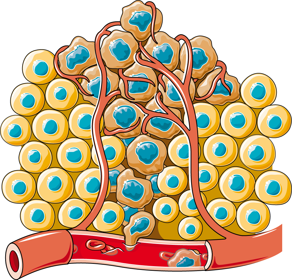 Cancer Dissemination - Vector Cancer Cell (1013x971), Png Download