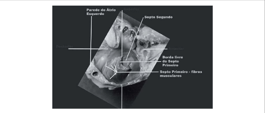 Forame Oval Visto Do Átrio Esquerdo - Foramen Ovale (850x363), Png Download
