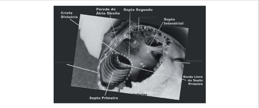 Forame Oval Visto Do Átrio Direito Para O Átrio Esquerdo - Atrium (850x355), Png Download