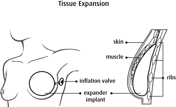 Types Of Breast Reconstruction (573x350), Png Download