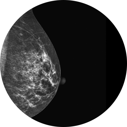 Breast Imaging - Thread Veins In Breast On Mammogram (440x440), Png Download