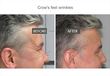 Wrinkle Correction - Wrinkle (420x291), Png Download