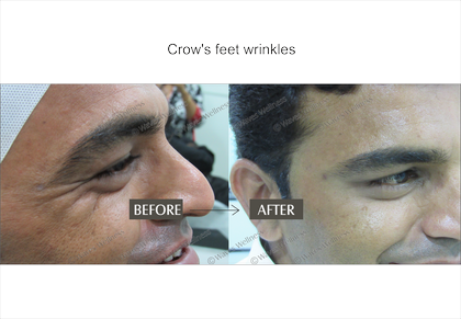 Wrinkle Correction - Wrinkle (420x291), Png Download