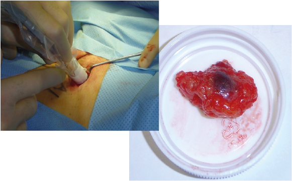 Management Of Penile Cancer Nodal Disease Oncology - Chutney (600x380), Png Download