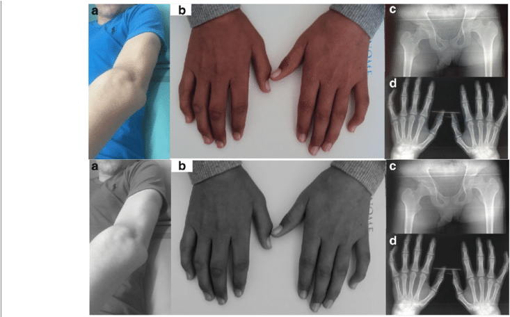 Clinical Features Of Scleroderma-like - Bone (850x455), Png Download