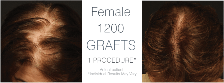 Hair Transplant Cost - Hair Transplantation (1024x372), Png Download