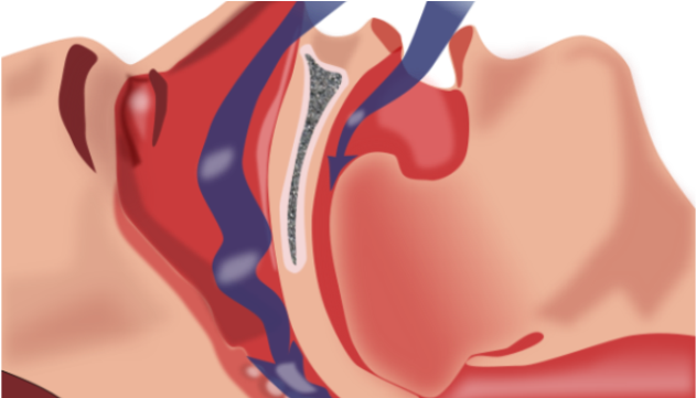 Brain Damage Caused By Severe Sleep Apnea Is Reversible - Upper Airway Cross Section (640x360), Png Download