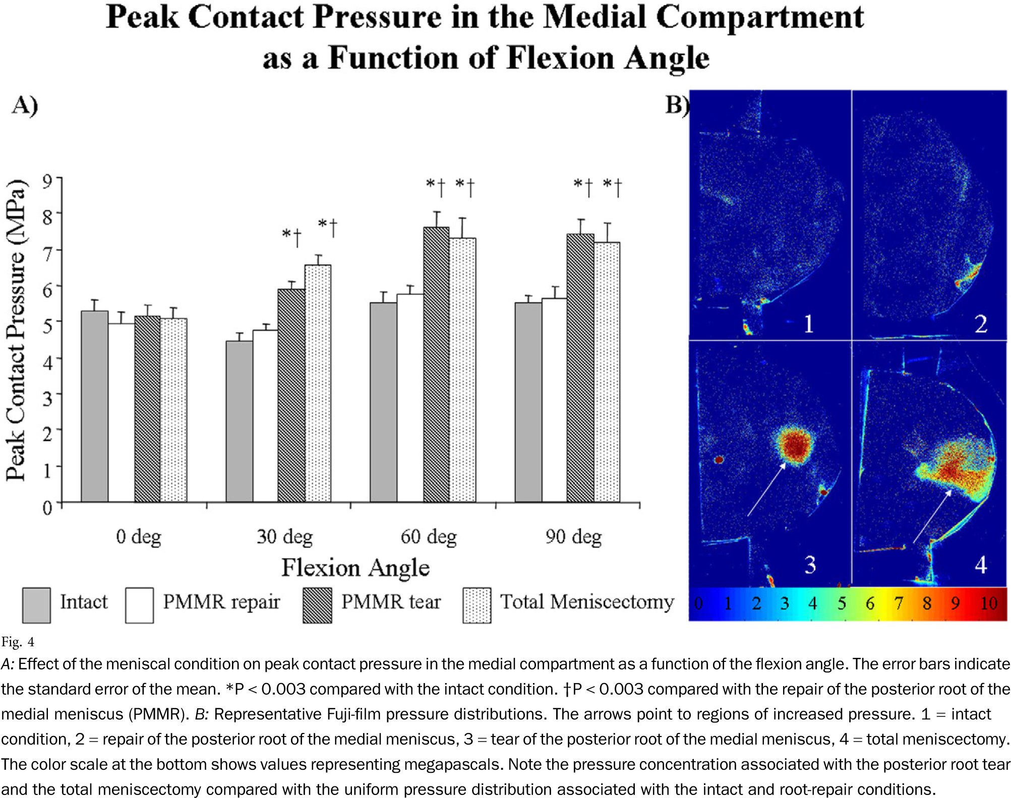 Effect Of The Meniscal Condition - Biomechanics Fuji Film Pressure Cadaver (2038x1619), Png Download