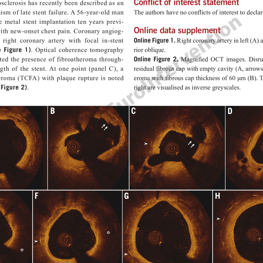 Arrowheads Indicate Stent Struts - Oct Lipid Rich Plaque (850x850), Png Download