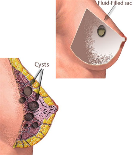 5girq5i15c8 Ds 179161 80 Dx358 Dy358 Cx179 Cy161 - Fibroadenoma De Seno (451x520), Png Download