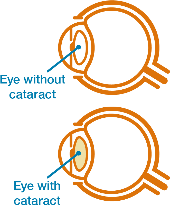 They Develop Gradually, Like Dirt Slowly Building Up - Illustration (664x810), Png Download