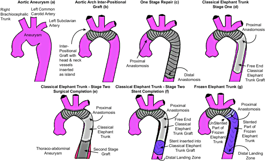 Graphical Representation Of Different Techniques For - Frozen Elephant Trunk Aorta (850x519), Png Download