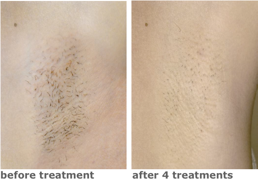 Mediostar Next Diode Laser Hair Reduction Before And - Hair Extensions Before And After (535x371), Png Download