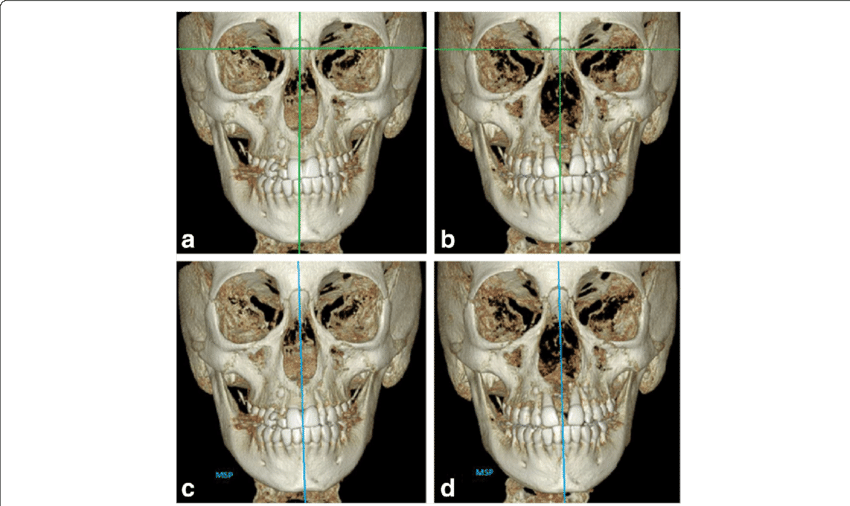 Reference Lines Used In Conventional 2d Postero Anterior - Cephalometric Analysis (850x506), Png Download
