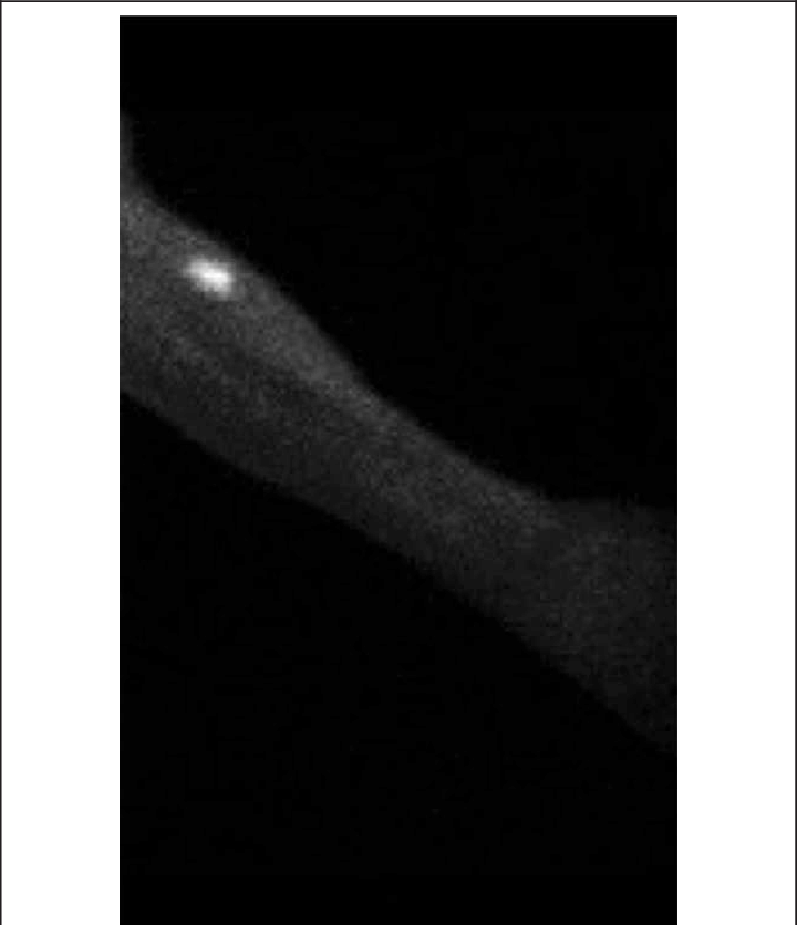 Tc Uptake At The Transplanted Forearm Site - Forearm (720x836), Png Download