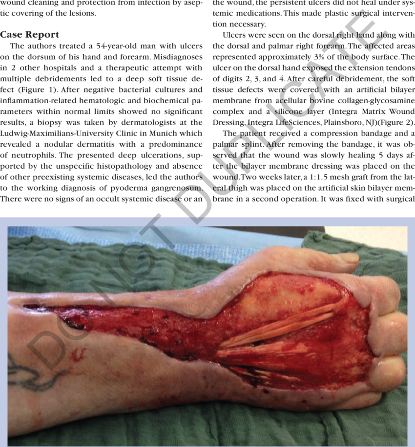 Preintervention, Intraoperative Dorsal View Of The - Extensor Digitorum Muscle (850x914), Png Download