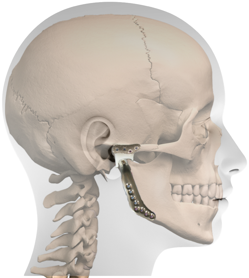 Profile Prosthesis - Frankfort Horizontal Plane Dental (925x946), Png Download
