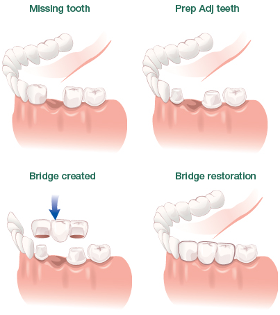 A Bridge May Represent An Excellent Alternative To - Diagram (403x453), Png Download