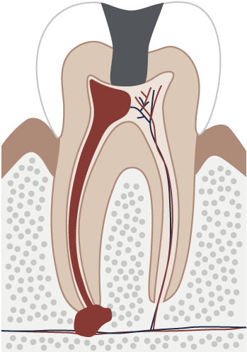 Diagram Of An Inflamed Tooth - Tooth (500x500), Png Download
