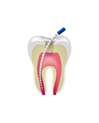 Presentation - Retreatment - Root Canal (323x399), Png Download