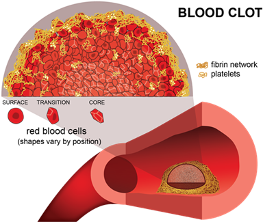 Researchers Look Inside Dangerous Clots With Optical - Blood Clotting Transparent (400x331), Png Download