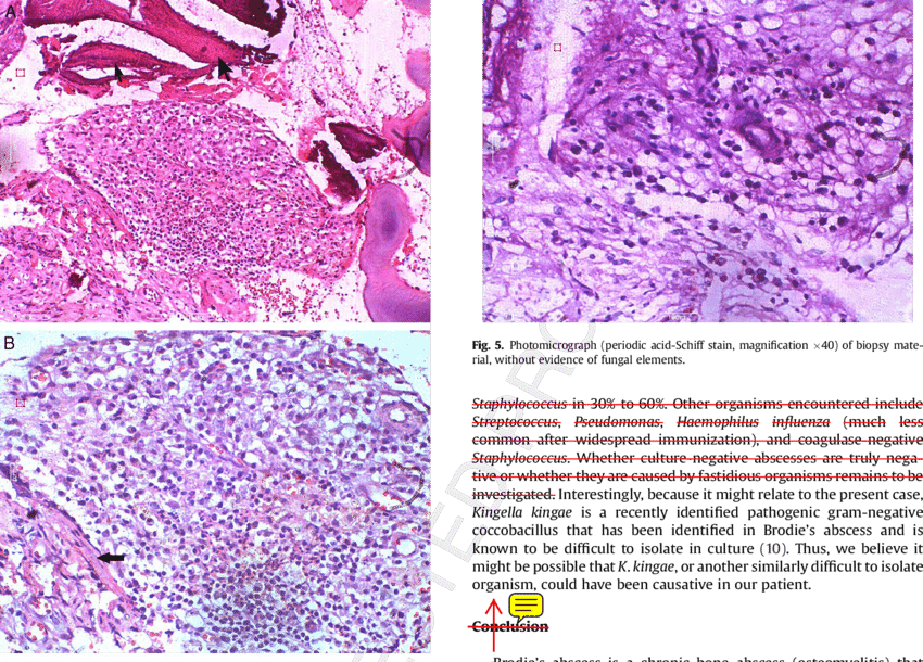 Photomicrographs Showing Dense Infiltrate Of Chronic - Inflammation (850x610), Png Download