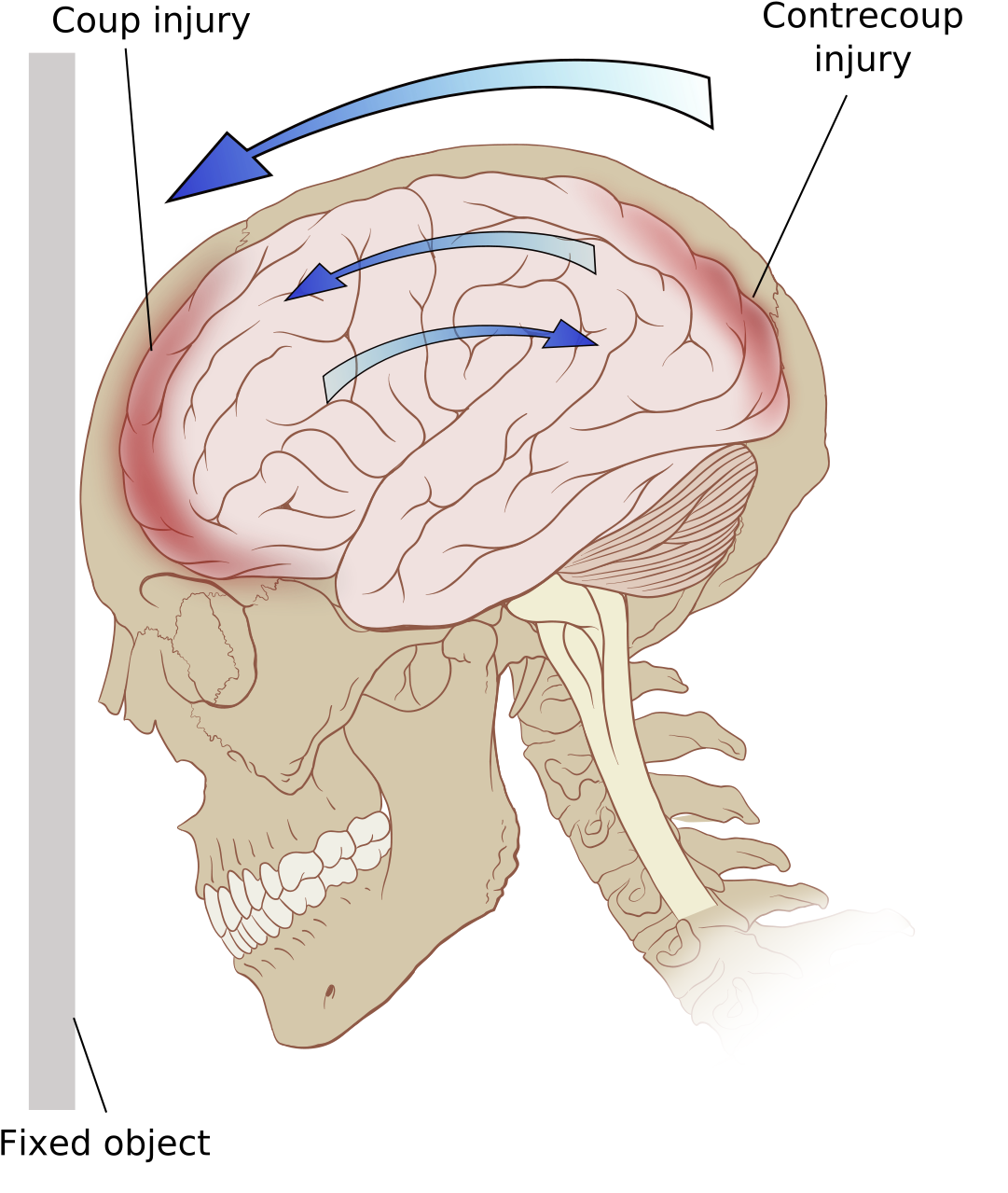 Types Of Brain Damage Abi (1200x1373), Png Download