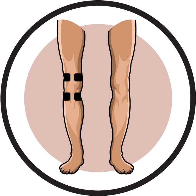 Knee Pain Degenerative Arthritis - Placement Of Electrodes For Knee (704x700), Png Download