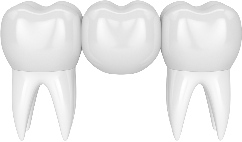 Crowns And Bridges - Bridge (960x700), Png Download