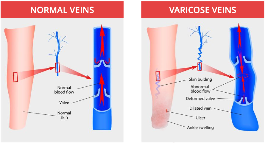 Open Skin Ulcers - Disease Of The Vascular System (890x480), Png Download