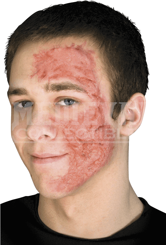 Burn Scar Gel - Burn Scars Latex Prosthesis (790x790), Png Download
